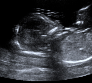5 Most Asked Questions About Nuchal Translucency Credentialing and Mint